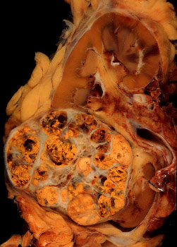 carcinoma renal