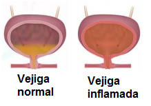 cistitis