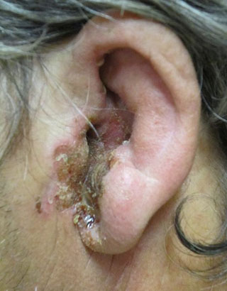 Otitis externa grave