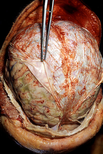 Autopsia: cerebro rodeado de pus (el pelaje amarillo-grisáceo alrededor del cerebro, debajo de la duramadre levantada con las pinzas), resultado de una meningitis bacteriana. Autopsia cerebral que demuestra signos de meningitis neumocócica en un paciente alcohólico. Las pinzas (centro) están retrayendo la duramadre (blanca). Debajo de la duramadre se encuentran las leptomeninges, que parecen edematosas y tienen múltiples focos hemorrágicos pequeños (rojo).