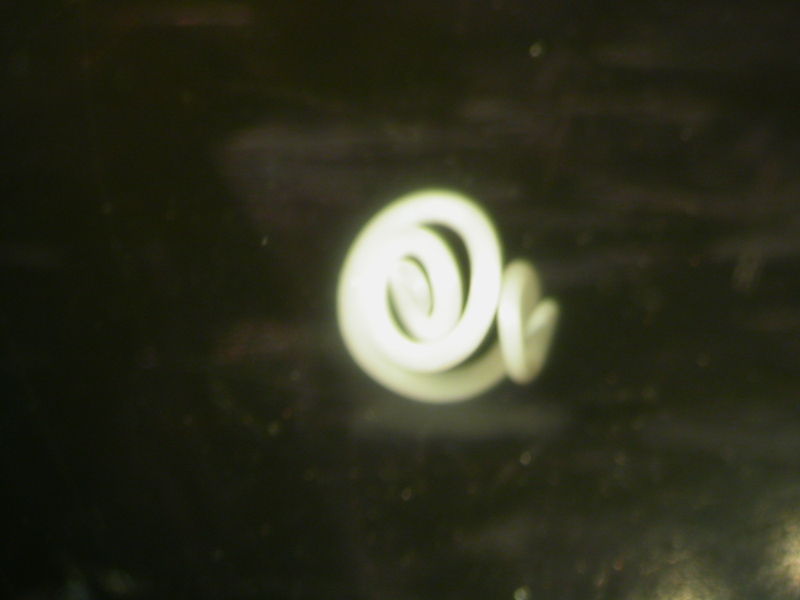 Anisakis simplex en una característica forma de "espiral de resorte de reloj"