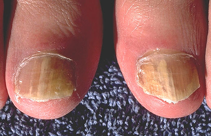 Onicomicosis debida a Trychophyton rubrum, en dedo gordo del pie derecho e izquierdo.