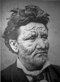 Un enfermo de lepra de 24 años de edad (1886)