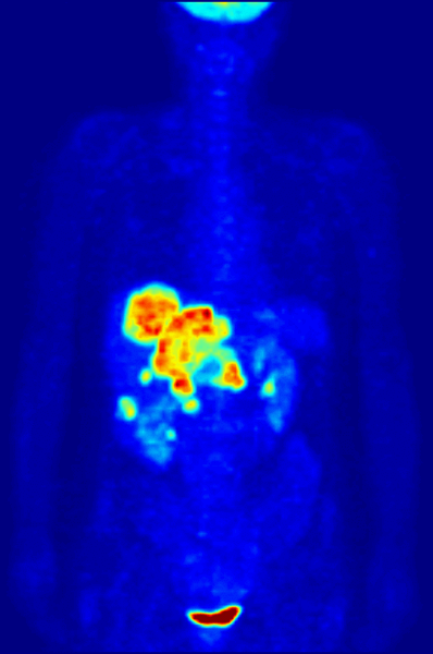 Proyección de máxima intensidad de una tomografía por emisión de positrones (PET) de cuerpo entero de una mujer de 79 kg de peso después de la inyección intravenosa de 371 MBq de 18 F-FDG (una hora antes de la medición). La investigación se ha realizado como parte de un diagnóstico de tumor antes de aplicar una radioterapia (paso de estadificación del tumor). Además de la acumulación normal del marcador en el corazón, la vejiga, los riñones y el cerebro, las metástasis hepáticas de un tumor colorrectal son claramente visibles dentro de la región abdominal de la imagen.