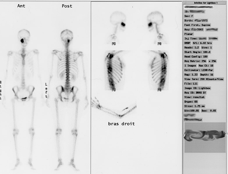 Gammagrafía del esqueleto humano de una mujer joven (lesión visible debajo de la órbita derecha).