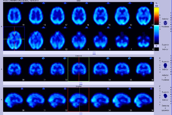 Se trata de una imagen de una prueba tomográfica (SPECT) del cerebro que permite el diagnóstico de la enfermedad de Parkinson. Se trata de una imagen de una prueba tomográfica (SPECT) del cerebro que permite el diagnóstico de la enfermedad de Parkinson.
