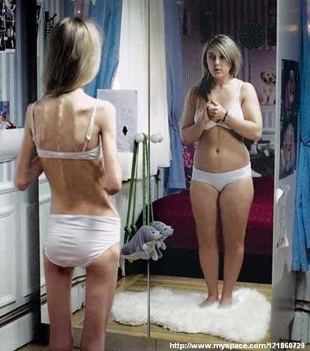 anorexia