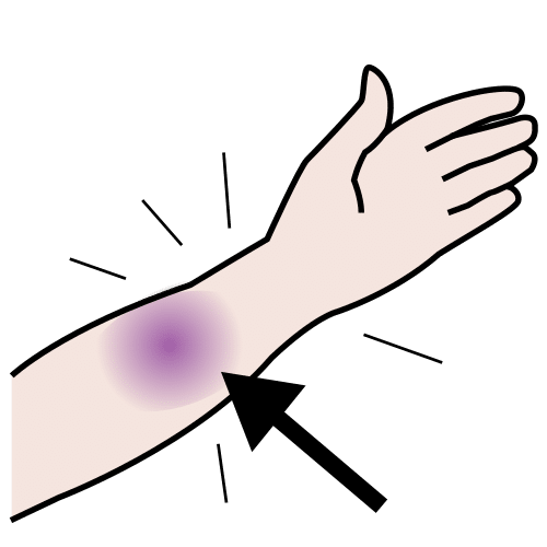 La imagen muestra un brazo con un cardenal.