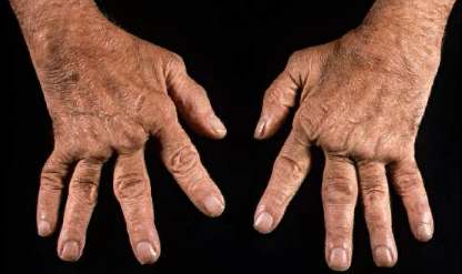 Un caso de artritis reumatoide