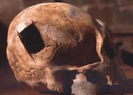 Trepanacin en uncrneo de la Amrica prehispnica. La trepanacin se daba en todos los pueblos primitivos del planeta.