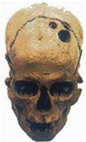 Crneo de hombre primitivo mostrando dos orificios por trepanacin. Pulsa aqu para saber ms.