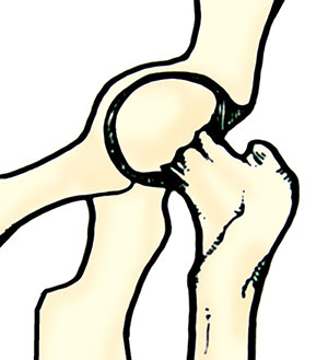 Articulación de la cadera Articulación de la cadera