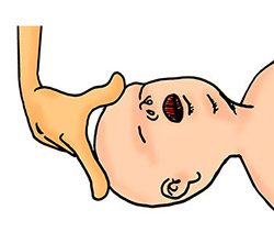 Comprobación cuerpo extraño en la boca de un lactante