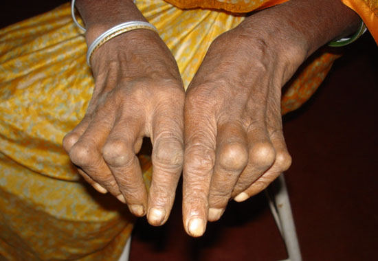 Artritis reumatoide