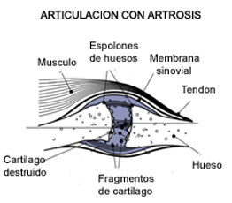 Artrosis
