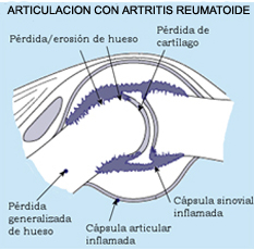 Artritis reumatoide